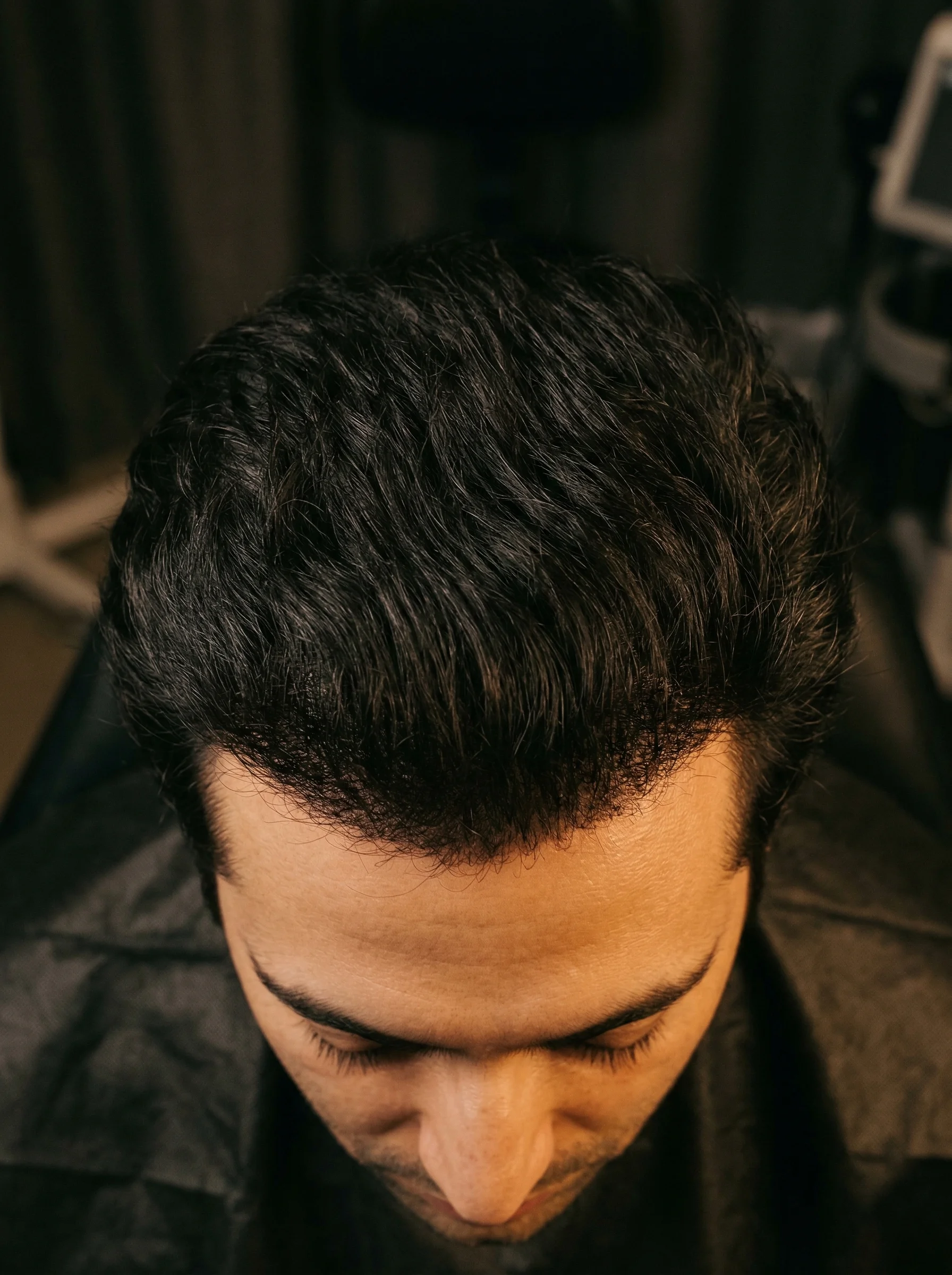 Dopo il trapianto - capelli naturali