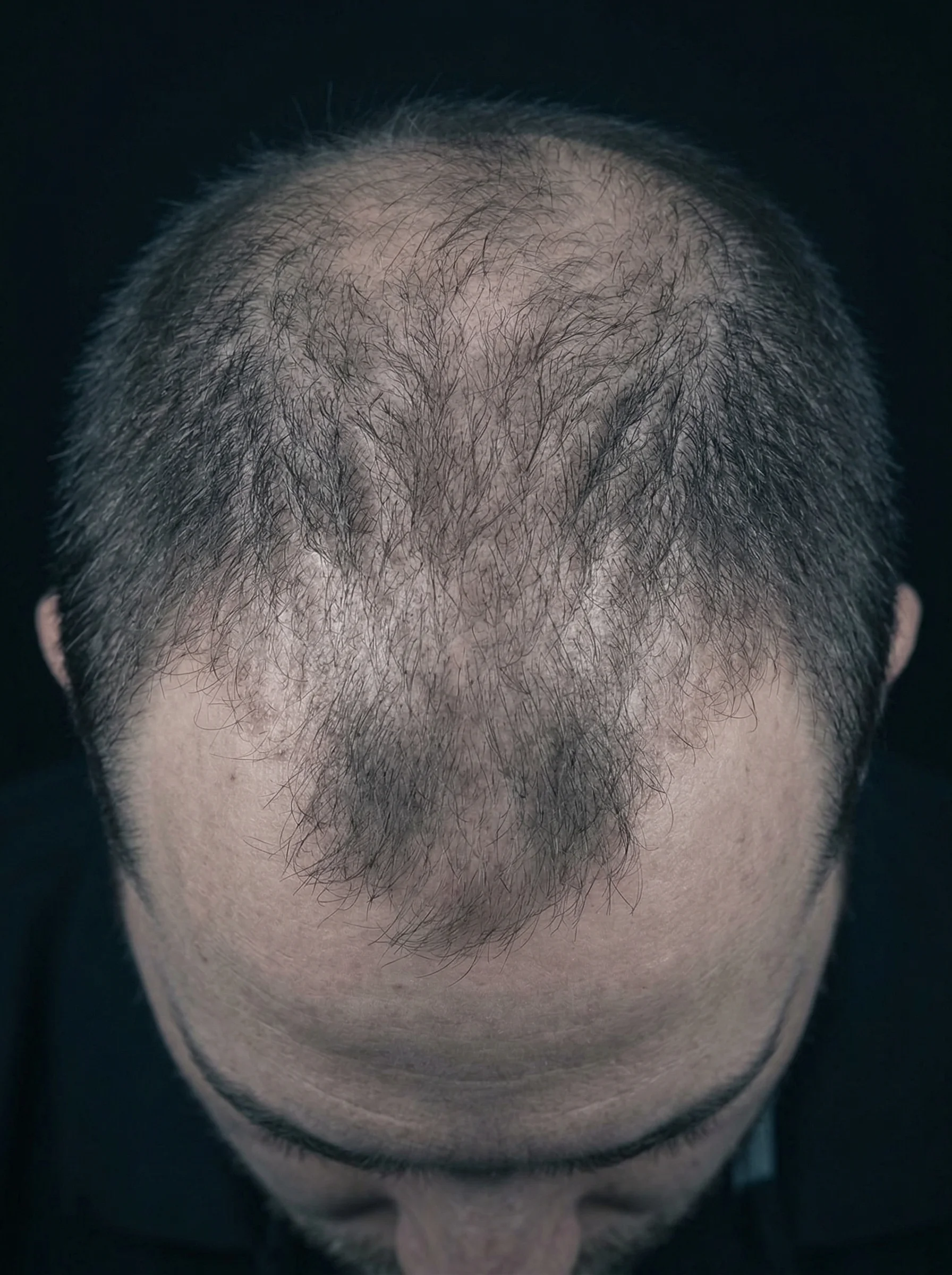 Prima del trapianto - diradamento