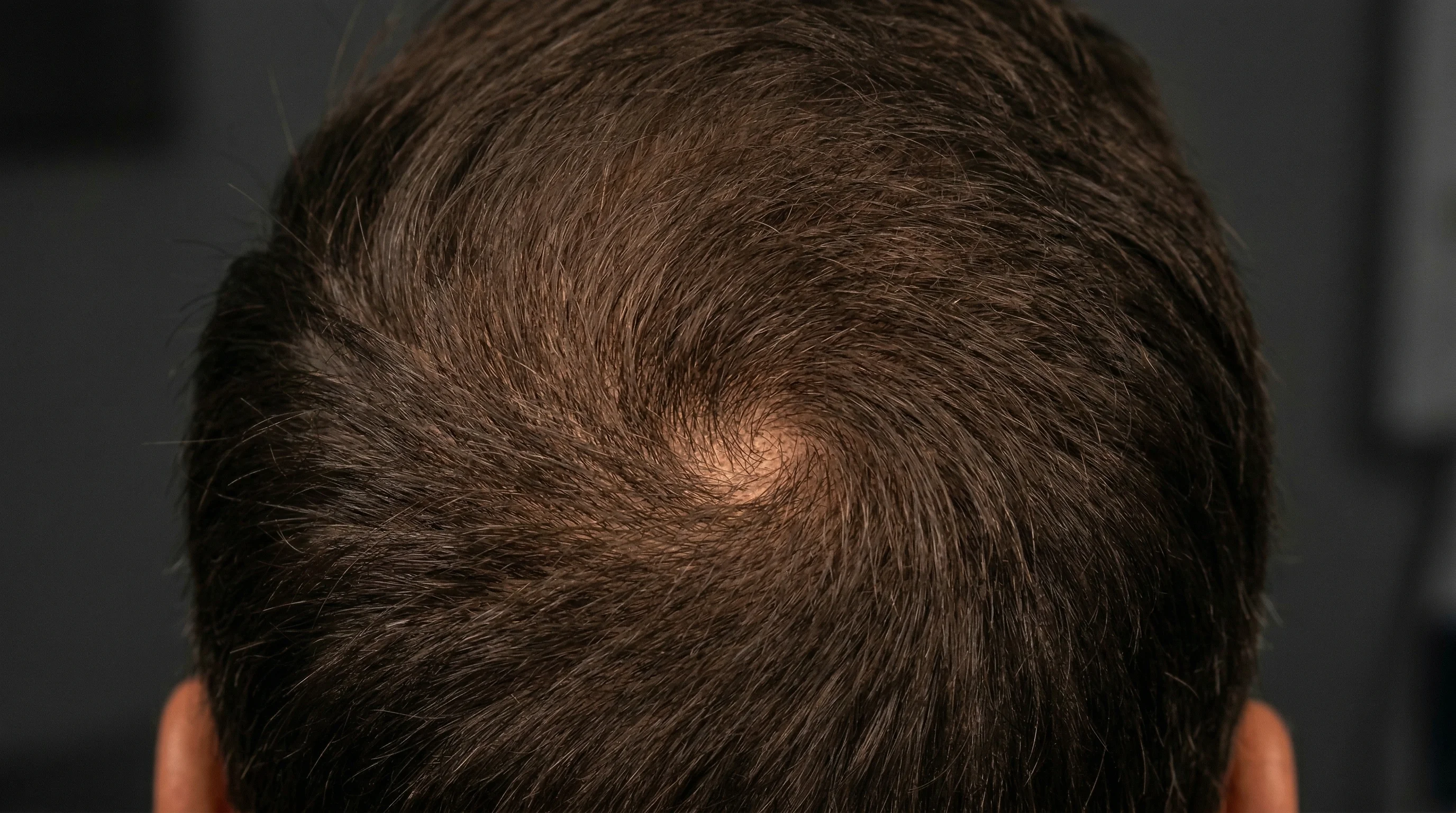 Caso DHI paziente 44 anni